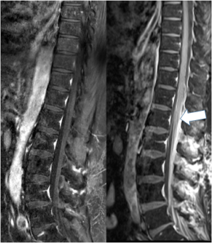 Inadvertent intrathecal application of vindesine and its neurological outcome: case report and systematic review of the literature.