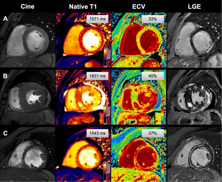 Myocardial native T1 and extracellular volume measurements at 5T: Feasibility study and initial experience.