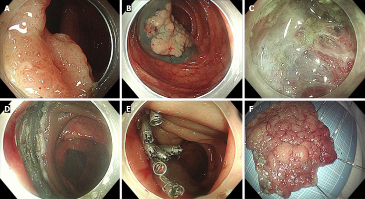 Endoscopic resection of colorectal laterally spreading tumors: Clinicopathologic characteristics and risk factors for treatment outcomes.