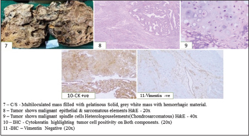 Carcinosarcoma of Uterus and Ovary-Clinical, Morphological, and Immunohistochemical Study of Case Series.