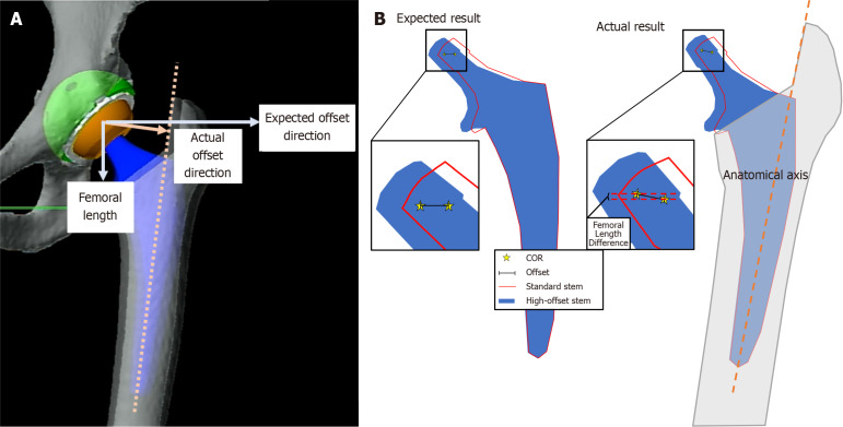 Pure high-offset stems can cause an unexpected increase in femoral length in robotic-assisted primary total hip arthroplasty.