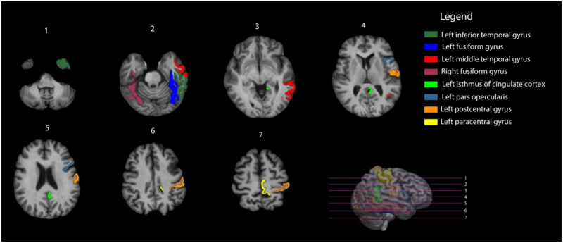 Increased functional network segregation in glioma patients posttherapy: A neurological compensatory response or catastrophe for cognition?
