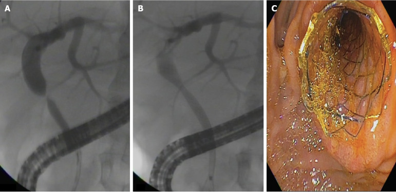 Long-term outcomes of post-transplant biliary anastomotic strictures: Endoscopic therapy with plastic and metal stents.