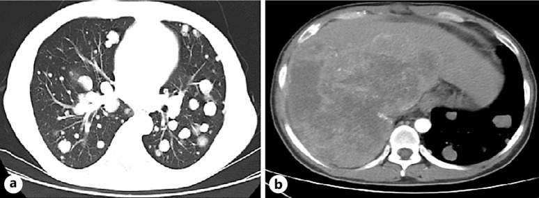 Naproxen in High-Temperature Neoplastic Fever: A Case Report Highlighting Its Distinctive Profile among Nonsteroidal Anti-Inflammatory Drugs.
