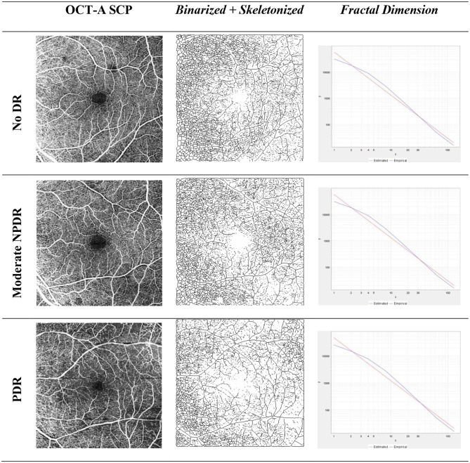 Retinal vessel tortuosity and fractal dimension in diabetic retinopathy.