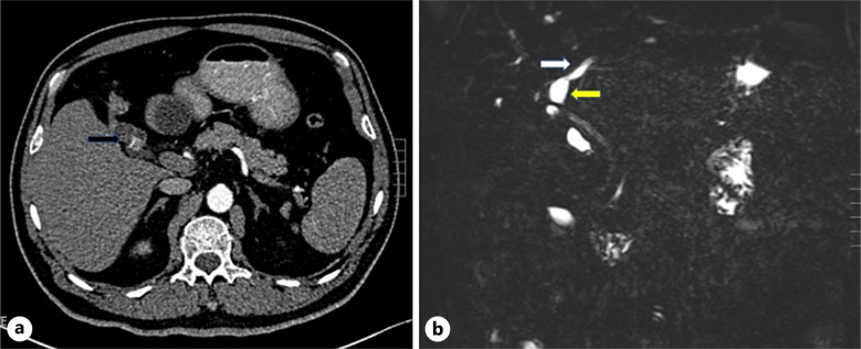 Calculus Cholecystitis Complicated with Variations of Extrahepatic Bile Duct: Clinical Experience and Aeromedical Analysis of 3 Cases in Aviation Pilots.