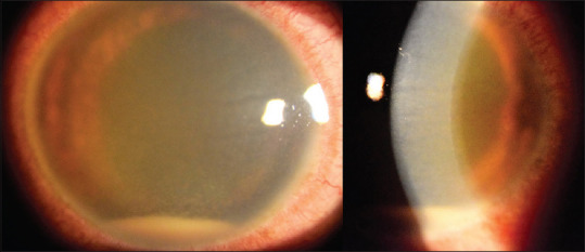 Tuberculous endogenous endophthalmitis presenting acute anterior uveitis with hypopyon.