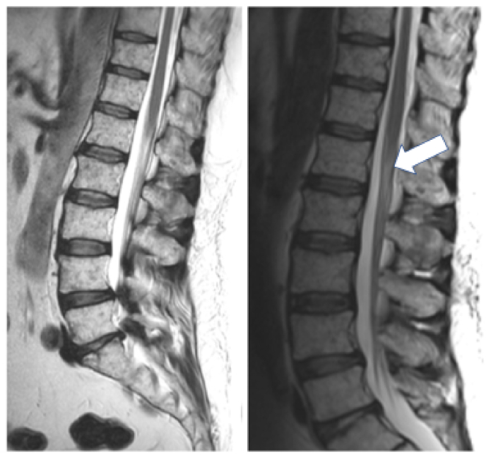 Inadvertent intrathecal application of vindesine and its neurological outcome: case report and systematic review of the literature.