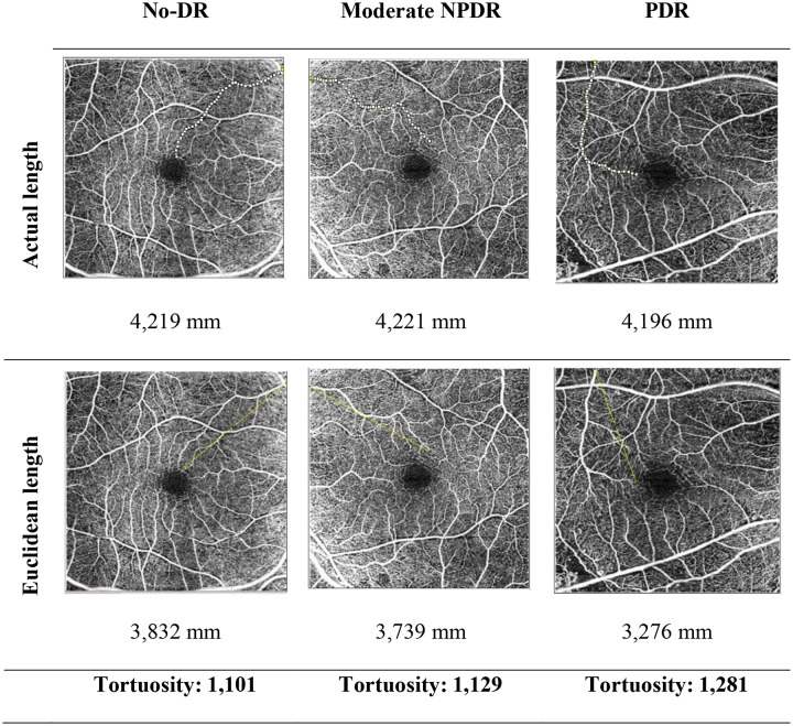 Retinal vessel tortuosity and fractal dimension in diabetic retinopathy.