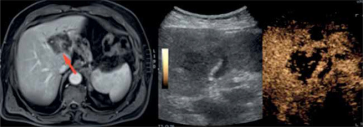 Application of contrast-enhanced ultrasound in liver biopsy.