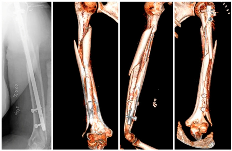 A Longitudinal Peri-Implant Diaphyseal Fracture Around a Locked Humeral Nail: A Case Report.