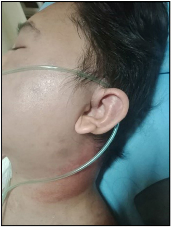 Rare head and neck myositis with reversible myelodysplastic syndrome: The first reported lupus manifestation as an initial symptom.