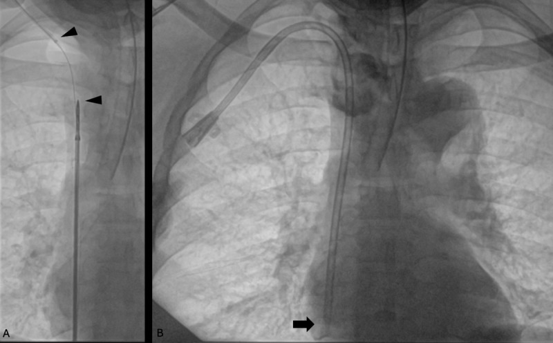 Surfacer Inside-Out Central Venous Catheterization Through an Occluded Inferior Vena Cava.