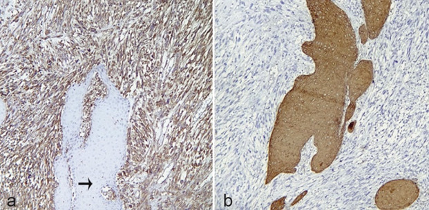 Infrequent Histopathologic Subtypes of Oral Squamous Cell Carcinoma: A Case Series with Emphasis on Histopathologic Characteristics.