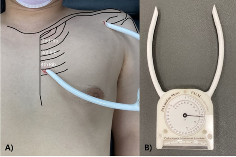 Pectoralis minor length index at 1 month postoperative can predict homolateral neuropathic pain 4 months after mastectomy with lymph node resection.