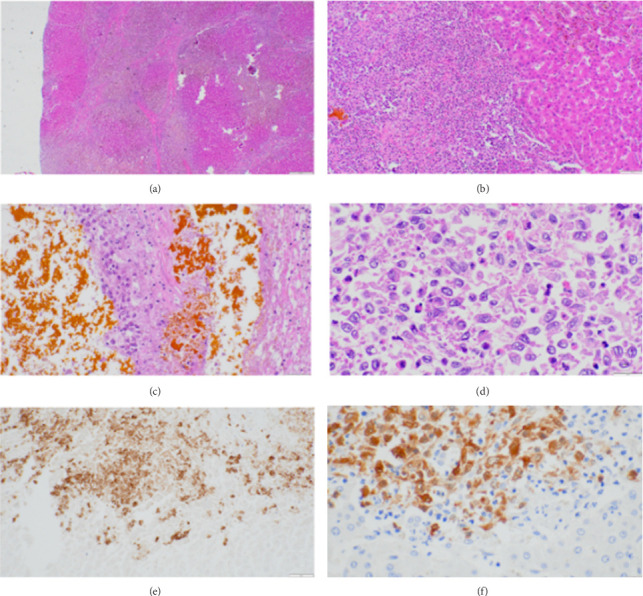 Liver Transplantation for Isolated Langerhans Cell Histiocytosis in an Adult.