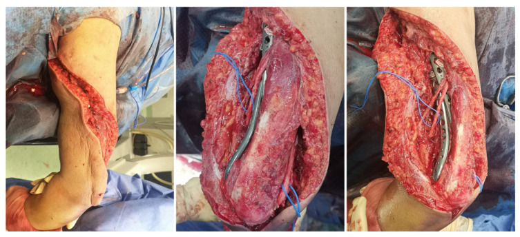 A Longitudinal Peri-Implant Diaphyseal Fracture Around a Locked Humeral Nail: A Case Report.