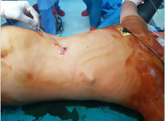 Firearm injuries in pediatric surgery: Pediatric trauma center experiences.