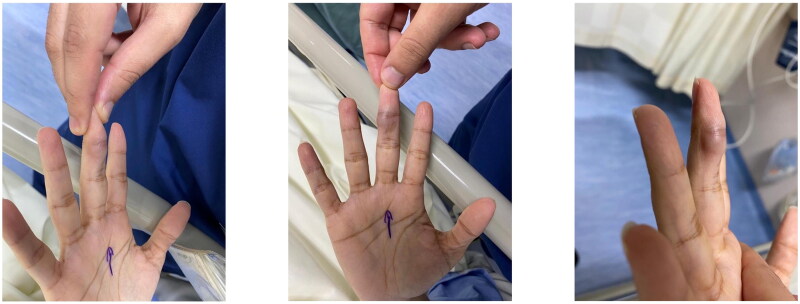 Intravascular papillary endothelial hyperplasia (Masson's tumor) of the finger: a case report and review of the literature.