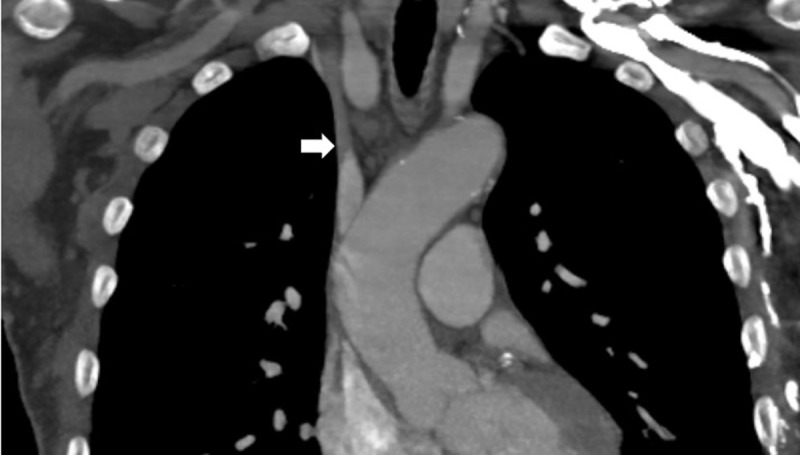 Surfacer Inside-Out Central Venous Catheterization Through an Occluded Inferior Vena Cava.
