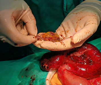 A Case of Strangulated Intestinal Obstruction Caused by Acquired Ileal Diverticulum.