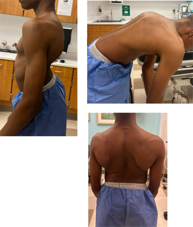 Surgical Sagittal Correction of Symptomatic Sweeping Thoracolumbar Lordosis in an Adolescent With Congenital Kyphoscoliosis.