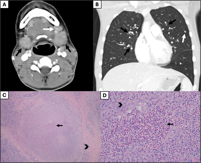 Two unique cases of eosinophilic granulomatosis with polyangiitis in childhood treated with anti-interleukin-5 therapy: infantile-onset and submandibular salivary gland involvement.