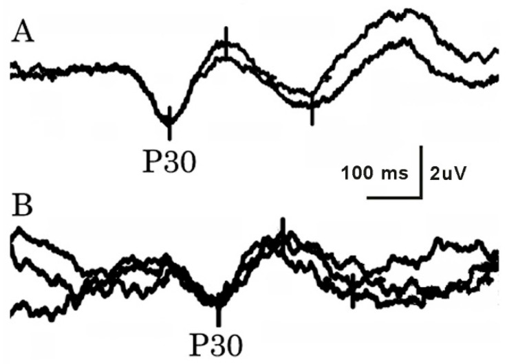 Electrodiagnostic Evaluation of Meralgia Paresthetica.