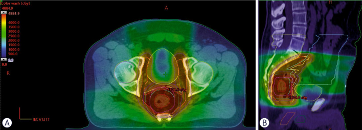 Sequencing of chemotherapy in total neoadjuvant treatment for rectal cancer does not predict radiation-induced lymphopenia.