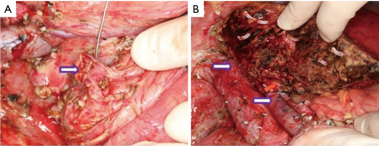 Type IVa bile duct dilatation in an adult female treated with living donor liver transplantation.