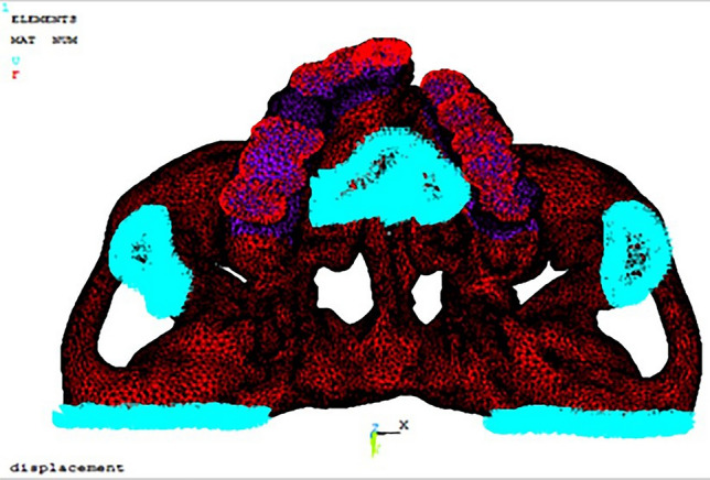 Evaluation of Stress in the Maxillary Complex of a Unilateral Cleft Lip and Palate on Simulated Occlusal Loading Using Finite Element Analysis.