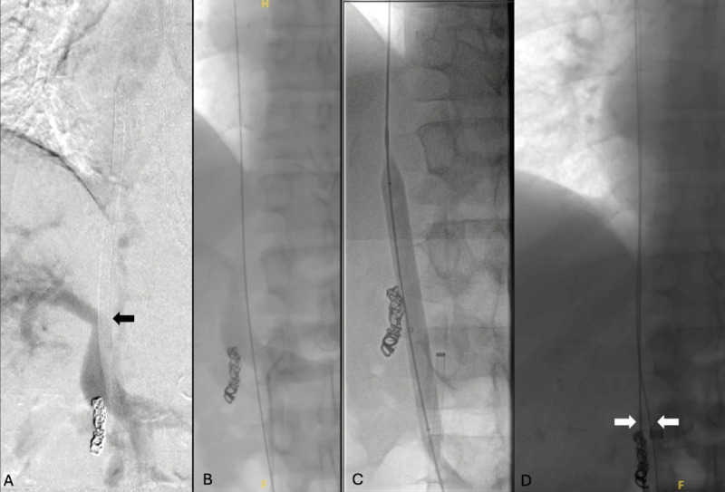 Surfacer Inside-Out Central Venous Catheterization Through an Occluded Inferior Vena Cava.