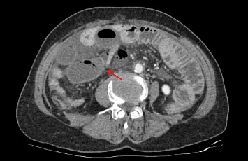 A Case of Strangulated Intestinal Obstruction Caused by Acquired Ileal Diverticulum.