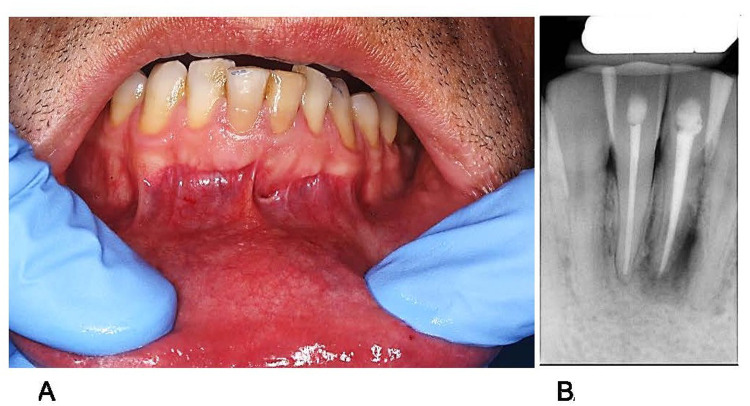 Case Report: Apical periodontitis due to calculus-like deposit on the external surface of the root apex.