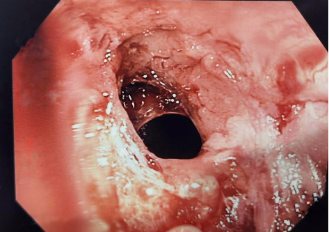 Recurrent Pouchitis Uncovering De Novo Celiac Disease.