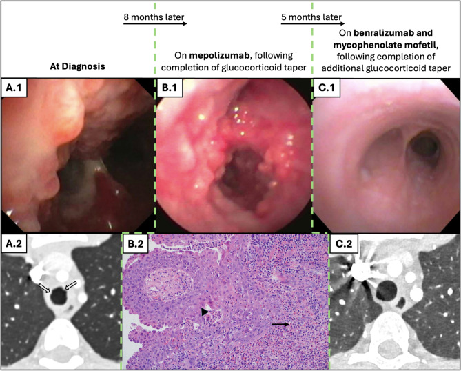 Two unique cases of eosinophilic granulomatosis with polyangiitis in childhood treated with anti-interleukin-5 therapy: infantile-onset and submandibular salivary gland involvement.