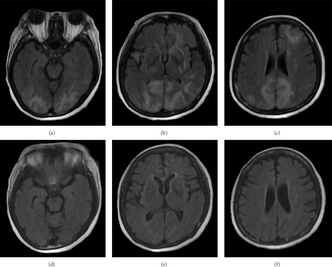 Posterior Reversible Encephalopathy Syndrome Induced by Mirtazapine Overdose: A Case Report.