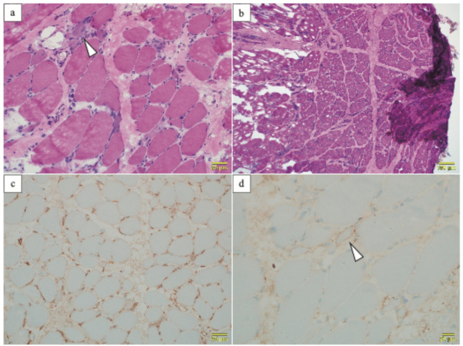 Pediatric immune-mediated necrotizing myopathy with anti-SRP antibodies targeting 19, 68, and 72 kda subunits.