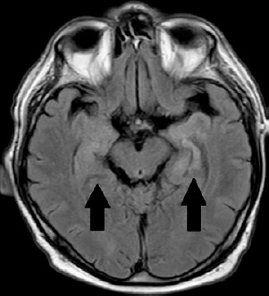 Anti-LGI1-antibody autoimmune encephalitis as a neurological paraneoplastic syndrome associated with gastrointestinal stromal tumour: a case report.