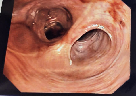 Recurrent Pouchitis Uncovering De Novo Celiac Disease.