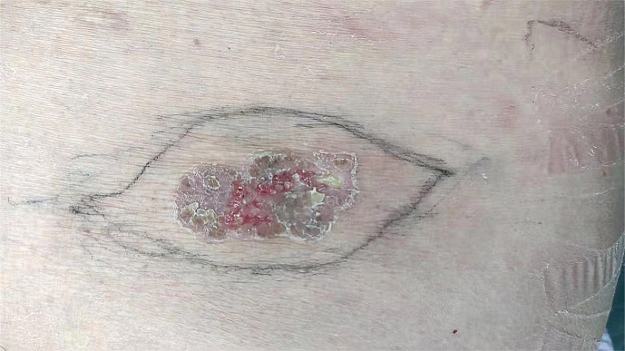 Malignant Hidroacanthoma Simplex: A Case Report.