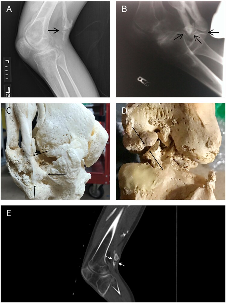 Ectopic pseudojoints in fibrodysplasia ossificans progressiva.