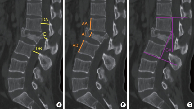 Endoscopic Decompression Combined With Percutaneous Pedicle Screw Fixation for AOSpine A3 or A4 Thoracolumbar Fractures With Neurological Deficits: A Retrospective Cohort Study.