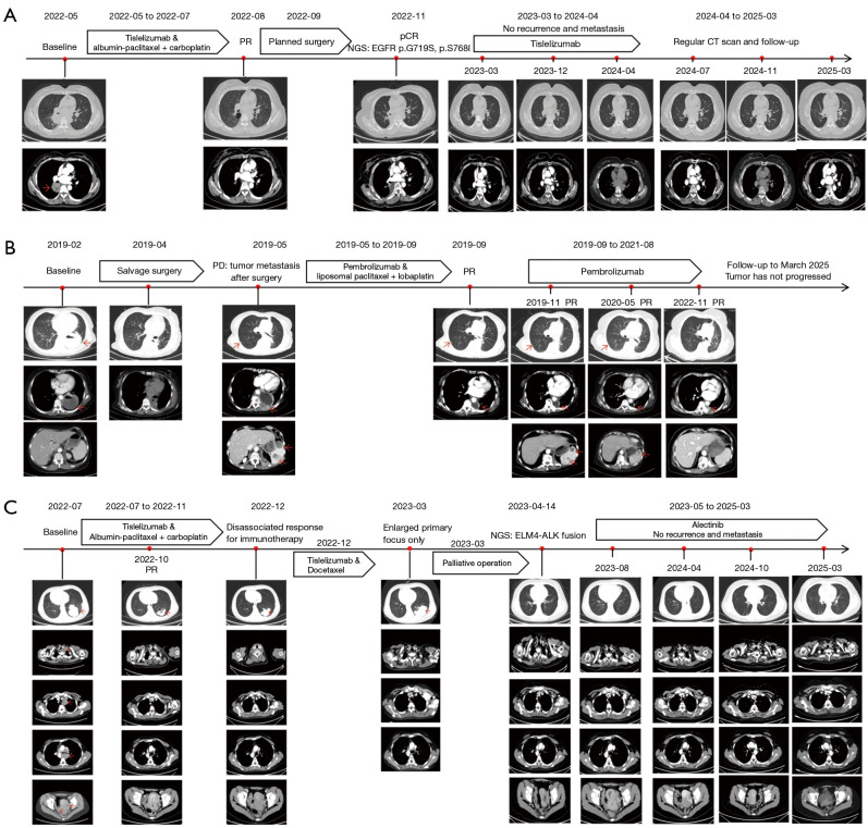 Good responses to first-line immunotherapy-included treatment in lung squamous carcinoma with rare driver gene mutations: a report of three cases.
