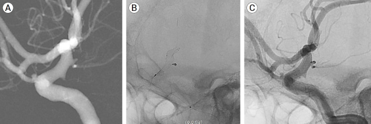 Clinical safety and efficacy of stent-assisted coil embolization with ACCERO stent in cerebral aneurysm: Short-term follow-up and precaution for use.