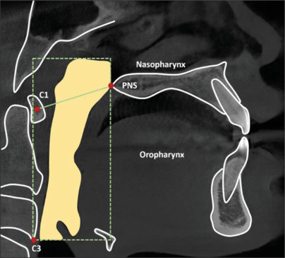 Which skeletal pattern should consider the correlation between the tongue volume versus the upper airway and craniofacial structure? A cross-sectional descriptive study in Vietnamese.