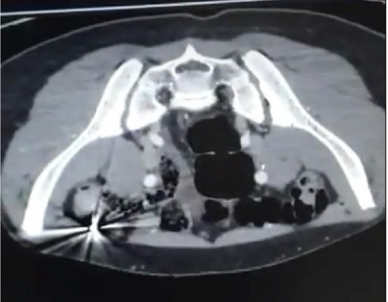 Firearm injuries in pediatric surgery: Pediatric trauma center experiences.