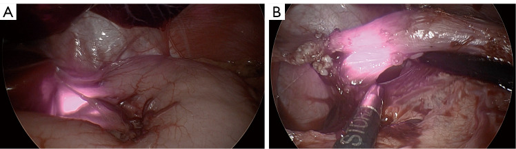 Novel use of a light-emitting nasogastric tube to enhance oesophageal dissection during laparoscopic fundoplication in children: a case report.