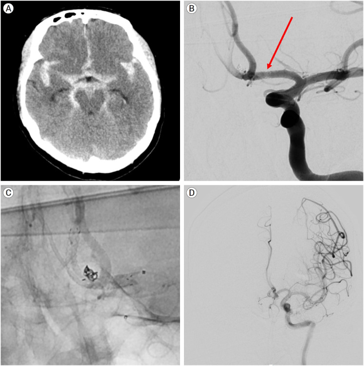 Clinical safety and efficacy of stent-assisted coil embolization with ACCERO stent in cerebral aneurysm: Short-term follow-up and precaution for use.