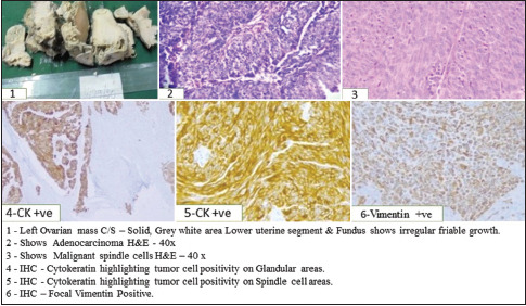 Carcinosarcoma of Uterus and Ovary-Clinical, Morphological, and Immunohistochemical Study of Case Series.